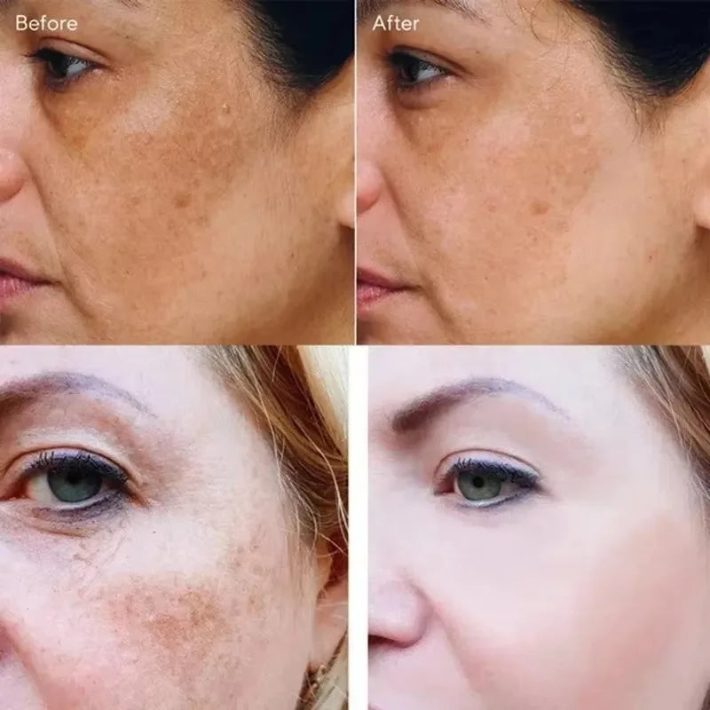 Dark Spot Brightening Cream – Eliminates Melanin, Melasma & Pigmentation, Korean Skin Care
